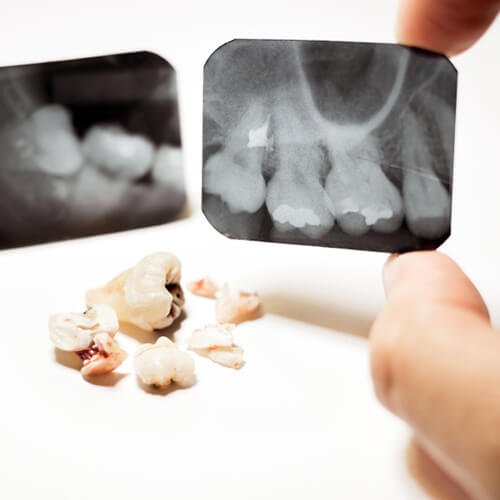 Самые частые травмы: перелом коронки или корня зуба, ушиб, вывих зуба.
