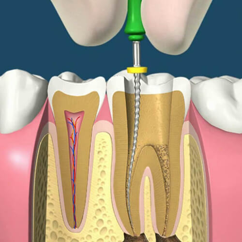 Зачем нужно перелечивание каналов зубов? Распломбировка, повторное лечение и пломбирование корневых каналов.