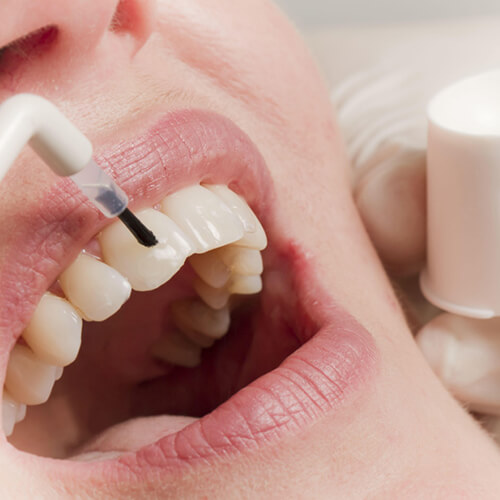 Реминерализация и фторирование зубов представляет собой восстановление структуры эмали (плотности и минерального состава)