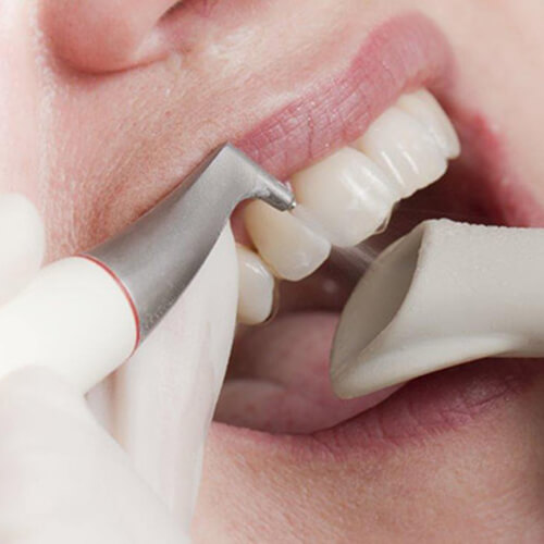 Ультразвуковая чистка зубов часто дополняется другими способами профессиональной чистки, например, аппаратом Air-Flow.