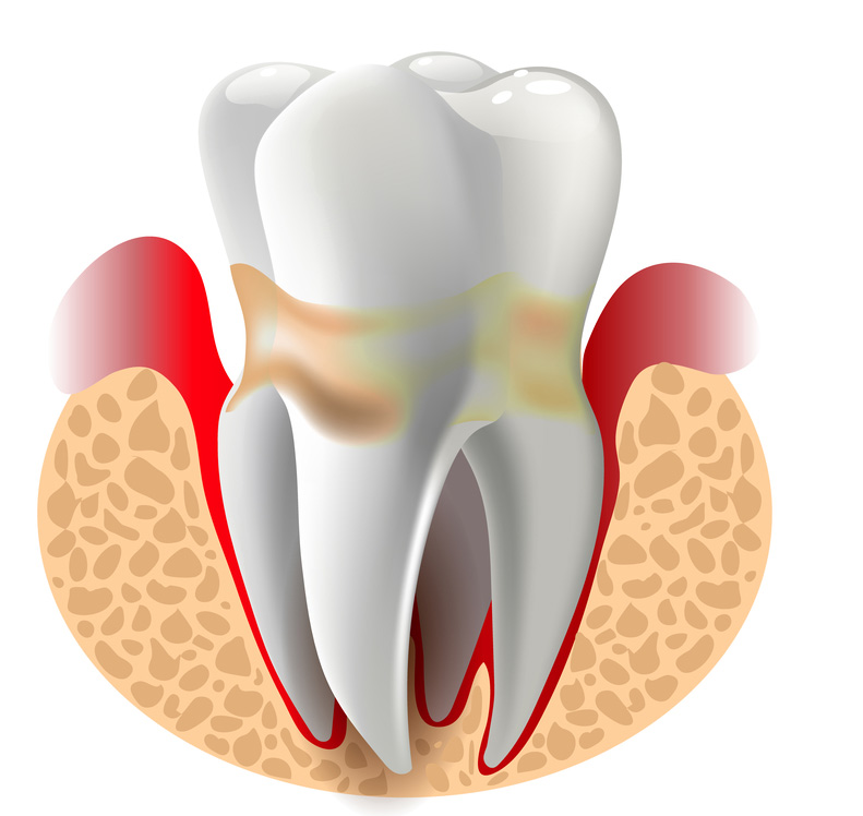 Периодонтит — это воспалительный процесс, который развивается в окружающих зубы тканях.
